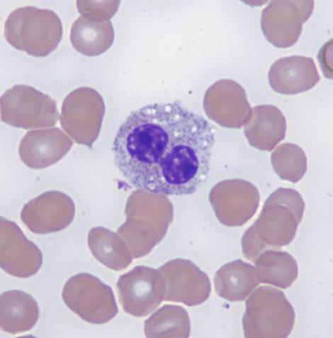 The BM aspirate smear shows a pseuto-Pelger-Huet-like neutrophil (Wright-Giemsa, 1000x).